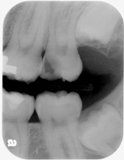 Digital Dental X-Ray