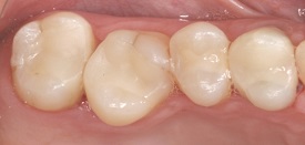 CEREC After