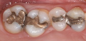 CEREC before