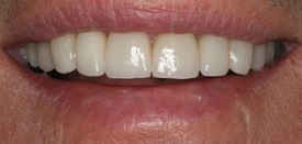 Veneers After